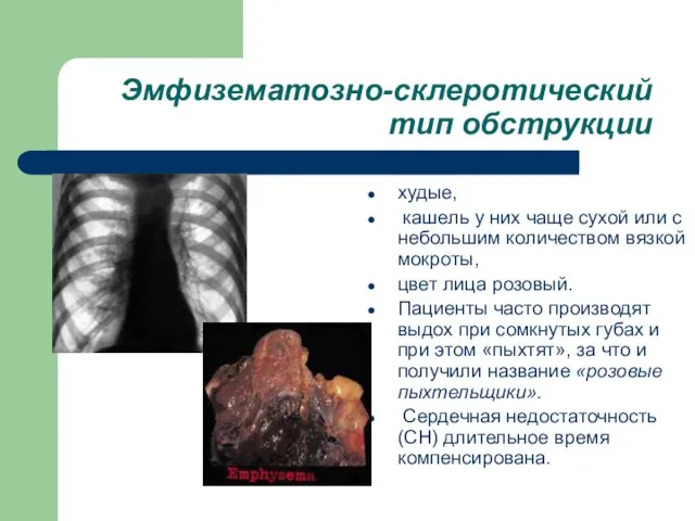 Эмфuзематозно-склеротический тип обструкции худые, кашель у них чаще сухой или с небольшим