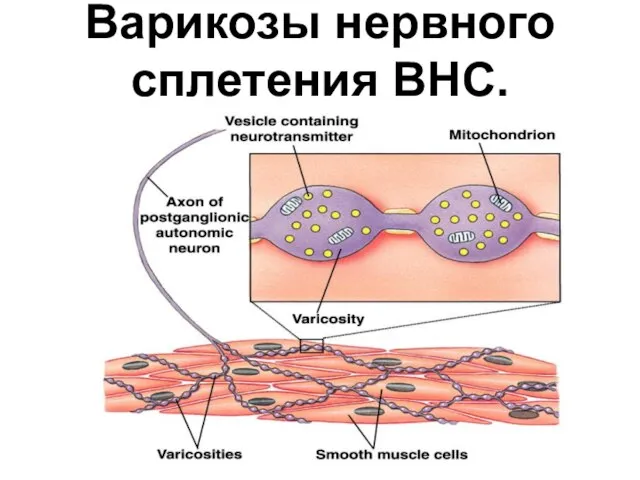 Варикозы нервного сплетения ВНС.