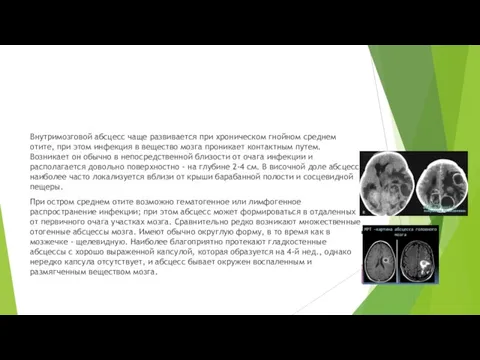 Внутримозговой абсцесс чаще развивается при хроническом гнойном среднем отите, при этом инфекция