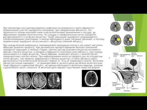 При контактном пути распространения инфекции на поверхности мозга образуется ограниченный участок энцефалита