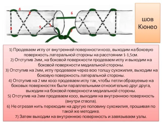 1) Продеваем иглу от внутренней поверхности косо, выходим на боковую поверхность латеральной