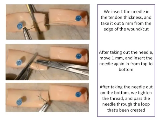 We insert the needle in the tendon thickness, and take it out