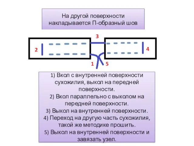 На другой поверхности накладывается П-образный шов 1) Вкол с внутренней поверхности сухожилия,