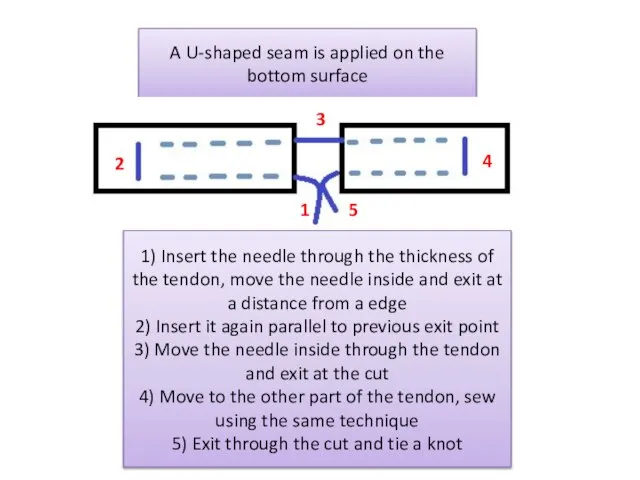 A U-shaped seam is applied on the bottom surface 1) Insert the