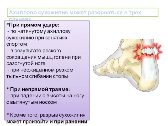 Ахиллово сухожилие может разорваться в трех случаях: *При прямом ударе: - по