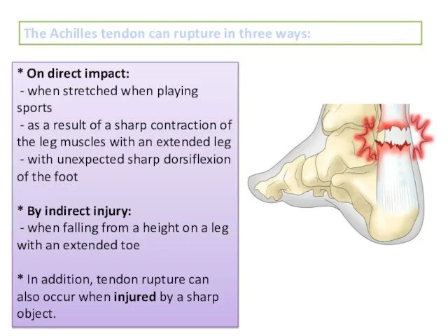 The Achilles tendon can rupture in three ways: * On direct impact: