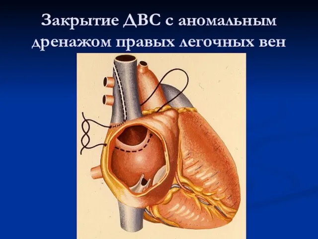 Закрытие ДВС с аномальным дренажом правых легочных вен