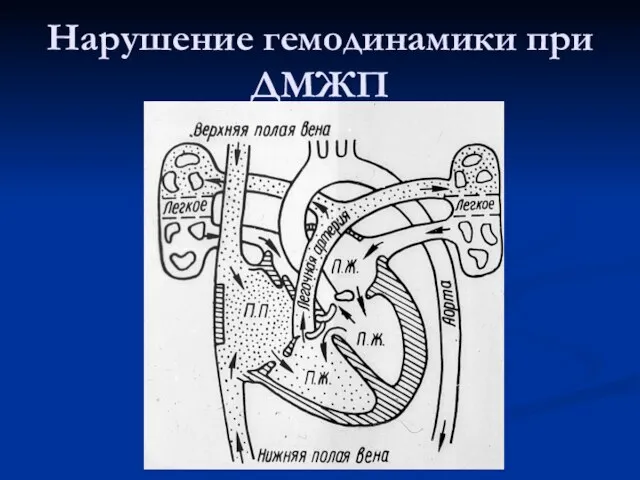 Нарушение гемодинамики при ДМЖП