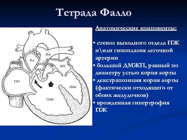 Тетрада Фалло Анатомические компоненты: стеноз выходного отдела ПЖ и\или гипоплазия легочной артерии