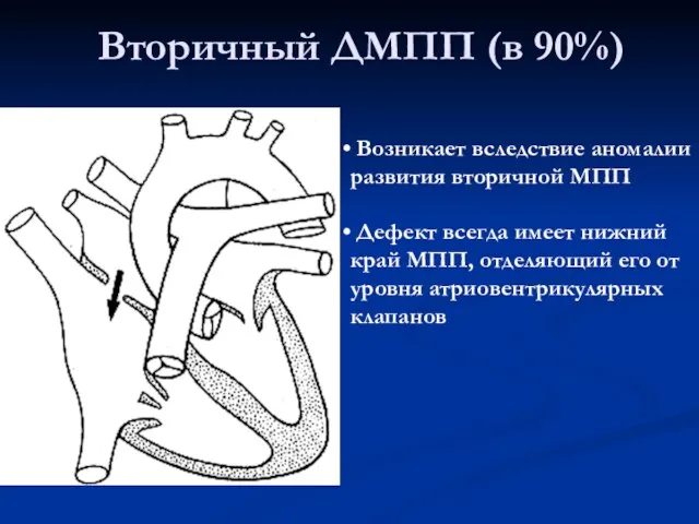 Вторичный ДМПП (в 90%) Возникает вследствие аномалии развития вторичной МПП Дефект всегда