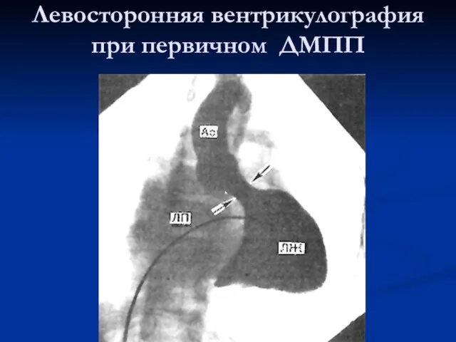 Левосторонняя вентрикулография при первичном ДМПП