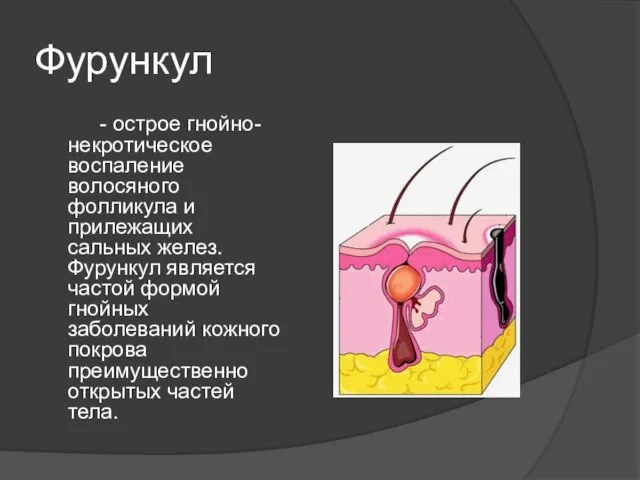 Фурункул - острое гнойно-некротическое воспаление волосяного фолликула и прилежащих сальных желез. Фурункул