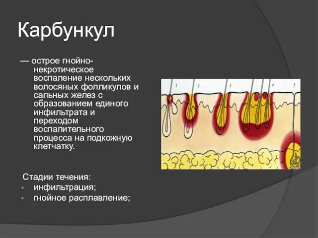 Карбункул — острое гнойно-некротическое воспаление нескольких волосяных фолликулов и сальных желез с