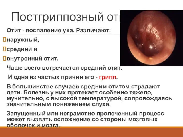 Постгриппозный отит Отит - воспаление уха. Различают: наружный, средний и внутренний отит.