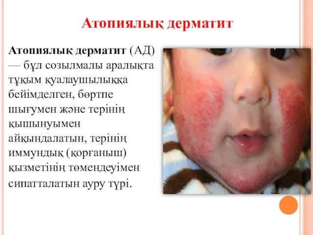 Атопиялық дерматит (АД) — бұл созылмалы аралықта тұқым қуалаушылыққа бейімделген, бөртпе шығумен