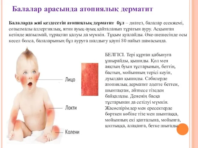 Балалар арасында атопиялық дерматит Балаларда жиі кездесетін атопиялық дерматит бұл – диатез,