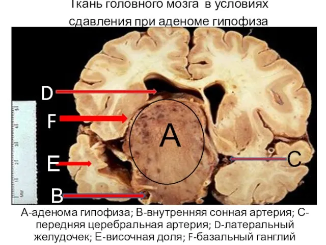 Ткань головного мозга в условиях сдавления при аденоме гипофиза А-аденома гипофиза; В-внутренняя
