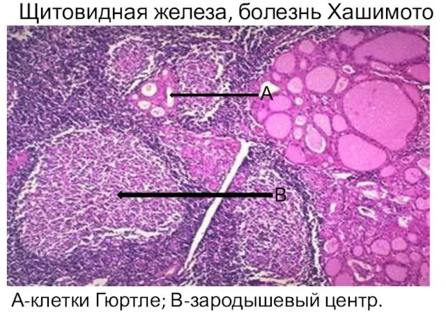 Щитовидная железа, болезнь Хашимото А-клетки Гюртле; В-зародышевый центр. А В