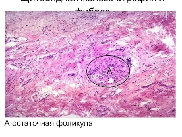 Щитовидная железа атрофия и фиброз А-остаточная фоликула А