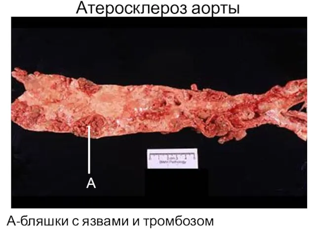 Атеросклероз аорты А-бляшки с язвами и тромбозом А