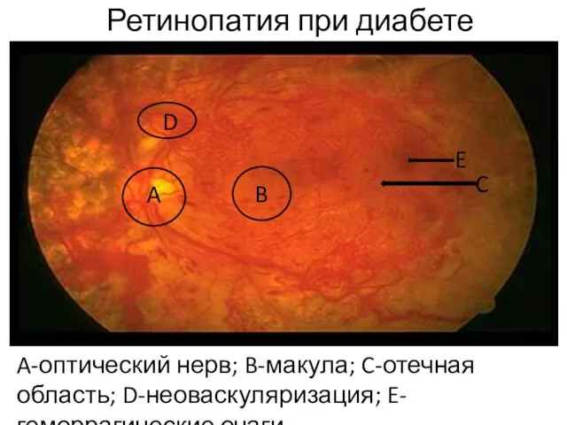 Ретинопатия при диабете A-оптический нерв; B-макула; C-отечная область; D-неоваскуляризация; E-геморрагические очаги A B C D E