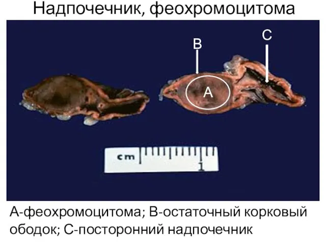 Надпочечник, феохромоцитома А-феохромоцитома; В-остаточный корковый ободок; С-посторонний надпочечник А В С