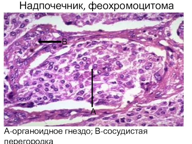 Надпочечник, феохромоцитома А-органоидное гнездо; В-сосудистая перегородка А В