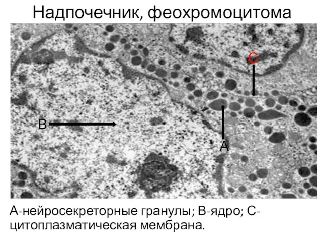 Надпочечник, феохромоцитома А-нейросекреторные гранулы; В-ядро; С-цитоплазматическая мембрана. А В С