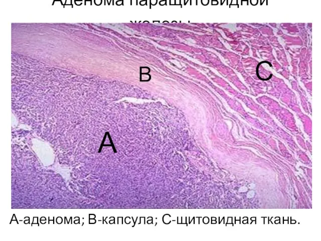Аденома паращитовидной железы А-аденома; В-капсула; С-щитовидная ткань. А В С