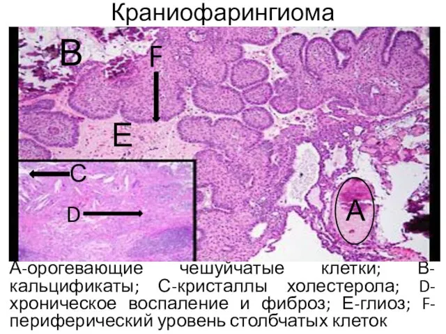 Краниофарингиома А-орогевающие чешуйчатые клетки; В-кальцификаты; С-кристаллы холестерола; D-хроническое воспаление и фиброз; Е-глиоз;
