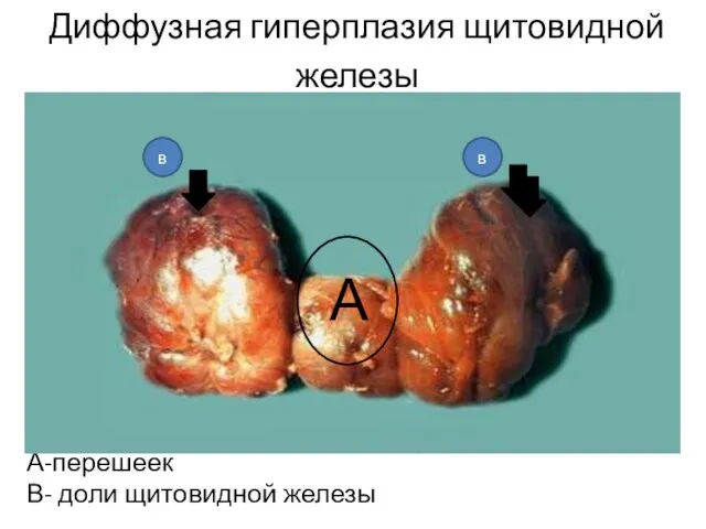 Диффузная гиперплазия щитовидной железы А-перешеек В- доли щитовидной железы А в в