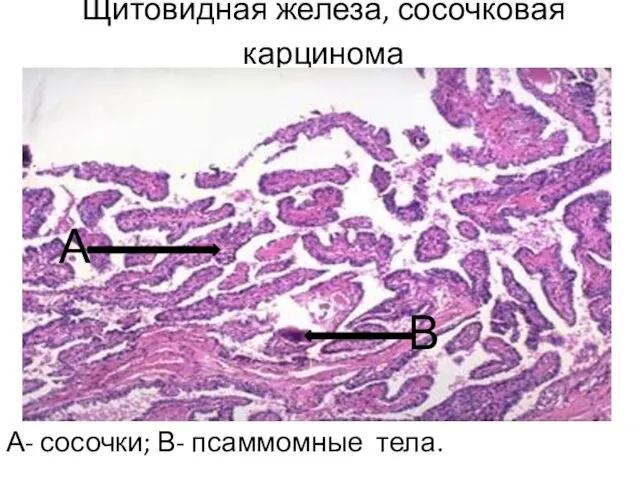 Щитовидная железа, сосочковая карцинома А- сосочки; В- псаммомные тела. А В