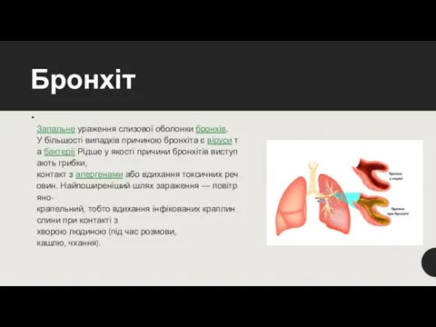 Бронхіт Запальне ураження слизової оболонки бронхів. У більшості випадків причиною бронхіта є