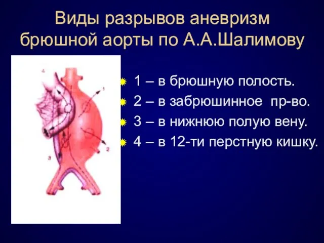 Виды разрывов аневризм брюшной аорты по А.А.Шалимову 1 – в брюшную полость.