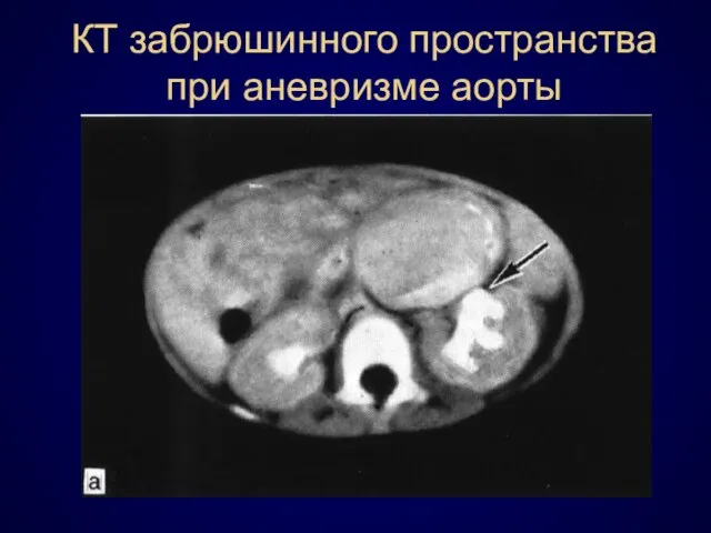 КТ забрюшинного пространства при аневризме аорты