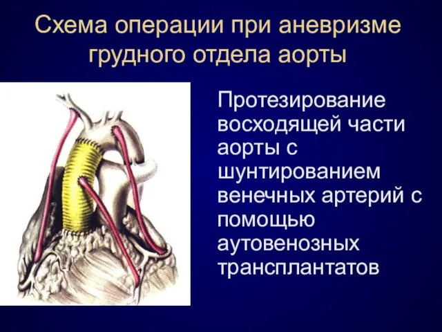 Схема операции при аневризме грудного отдела аорты Протезирование восходящей части аорты с