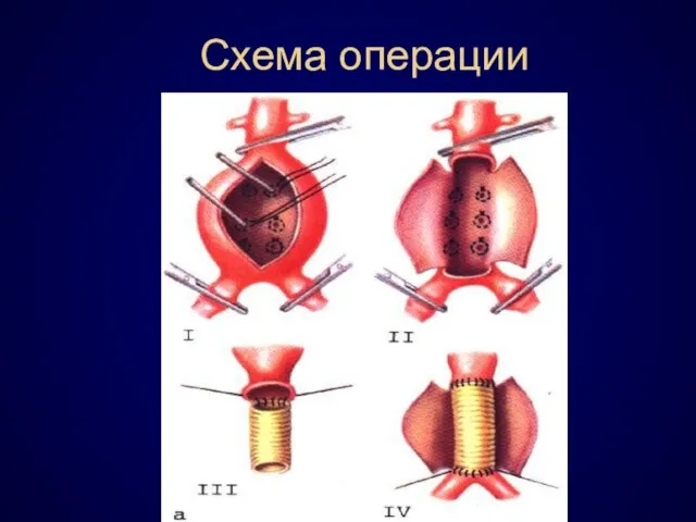 Схема операции