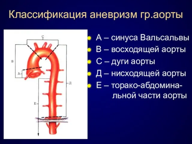 Классификация аневризм гр.аорты А – синуса Вальсальвы В – восходящей аорты С