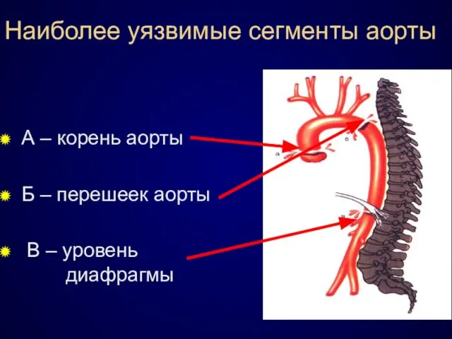 Наиболее уязвимые сегменты аорты А – корень аорты Б – перешеек аорты В – уровень диафрагмы