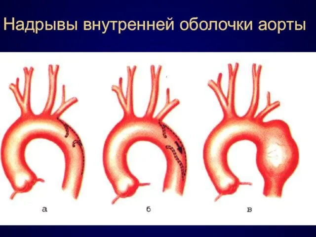 Надрывы внутренней оболочки аорты