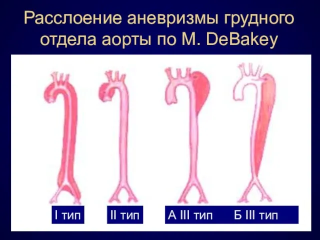 Расслоение аневризмы грудного отдела аорты по M. DeBakey I тип II тип