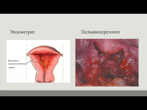 Эндометрит Пельвиоперетонит