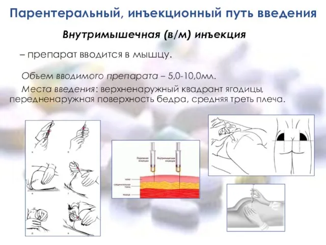 Парентеральный, инъекционный путь введения Объем вводимого препарата – 5,0-10,0мл. Места введения: верхненаружный