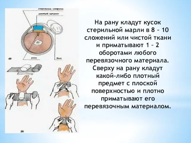 На рану кладут кусок стерильной марли в 8 – 10 сложений или