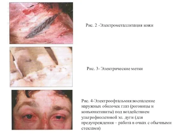 Рис. 2 -Электрометаллизация кожи Рис. 4-Электроофтальмия:воспаление наружных оболочек глаз (роговицы и конъюнктивиты)