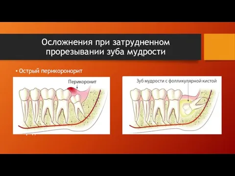 Осложнения при затрудненном прорезывании зуба мудрости Острый перикоронорит Параденталъные кисты