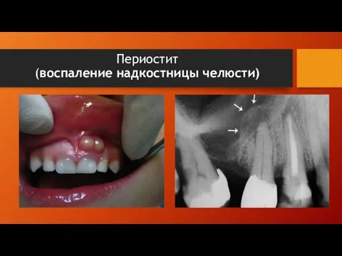 Периостит (воспаление надкостницы челюсти)