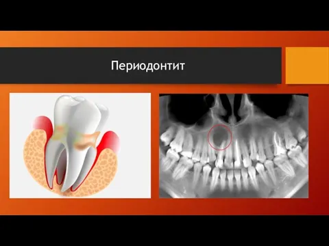 Периодонтит