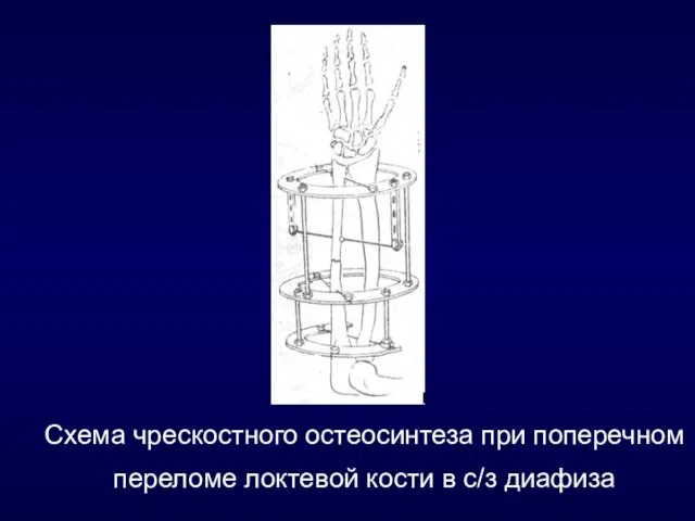 Схема чрескостного остеосинтеза при поперечном переломе локтевой кости в с/з диафиза