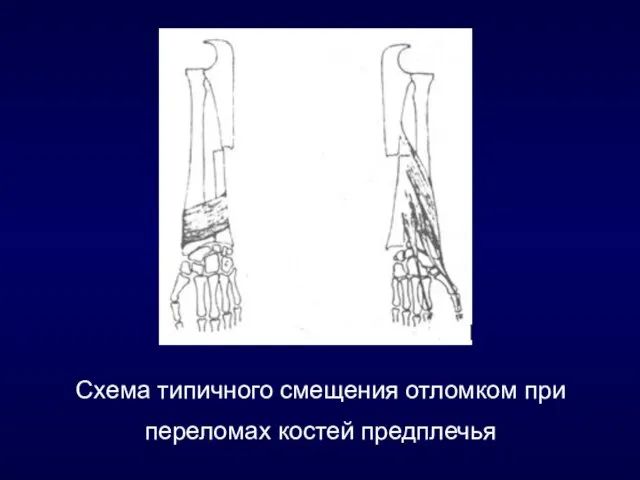 Схема типичного смещения отломком при переломах костей предплечья